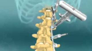 Scoliosis Spinal Fusion Animation [upl. by Yuji]