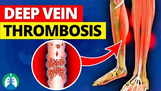 Deep Vein Thrombosis DVT  Quick Medical Overview [upl. by Sig]