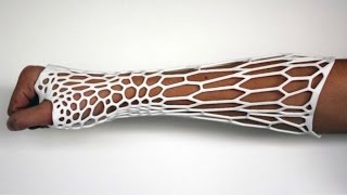 3Dprinted Cortex Exoskeleton may be the future of orthopedic casts [upl. by Aicilev]