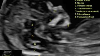 Ecografía Morfológica en Primer Trimestre Todo lo que se debe evaluar en un corte sagital alto [upl. by Yrrak522]