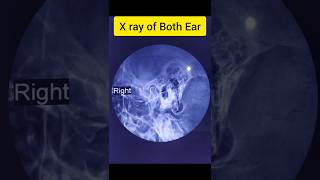 XRay Of Both EarSchuller Views [upl. by Hess]