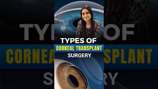 Types Of Corneal Transplant Surgery [upl. by Aisor155]