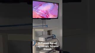 Laproscopic Surgery in Etawah [upl. by Rakso]