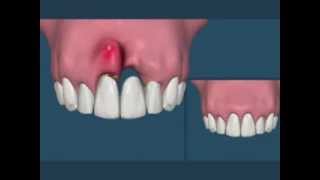 Compare Ponte Fixa ou Implante [upl. by Berkie]