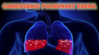 Cardiogenic Pulmonary Edema  CRASH Medical Review Series [upl. by Emaj]