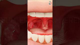 Tonsil Removal Surgery ↪ 3D Medical Animation Tonsil Tonsillectomy Surgery Shorts [upl. by Zosema]