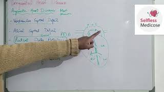 FCPS part 1CVS lecture 20 ACYANOTIC HEART DISEASES made easy [upl. by Duston963]