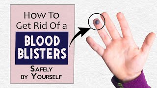 How to Get Rid of a Blood Blister Safely by Yourself [upl. by Ahsenek]