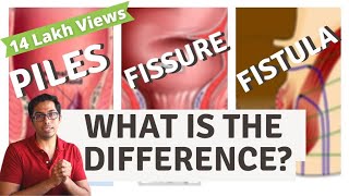 Piles  Fisure  Fistula  Difference explained  Dr Vishal Tomar  Open Consult [upl. by Sachsse362]