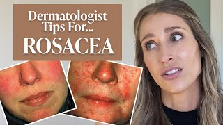 Dermatologist’s Guide to Rosacea What Is It Dos amp Don’ts Treatment Tips amp More  Dr Sam Ellis [upl. by Gnouh]