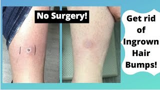 Dermatofibromas Removal – Get rid of hard scars [upl. by Adnolehs]