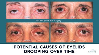 Possible Causes of Drooping Eyelids Eyelid Ptosis in Adults [upl. by Eirehc]