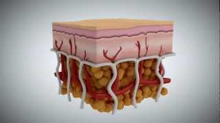 Cellulite What It Is What Causes It and How to Treat It [upl. by Fabri692]