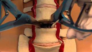 Synthes Spine ProDiscL Lumbar Total Disc Replacement Demonstration Video [upl. by Fugazy]