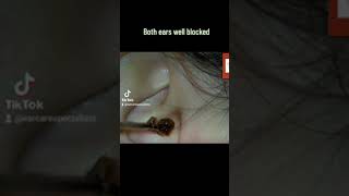 Both ears blocked with wax satisfying extraction ear earwax earcarespecialists audiology [upl. by Moersch717]