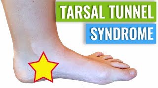 Tarsal Tunnel Syndrome Treatment amp Diagnosis [upl. by Nnyledam525]