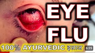 आँखा पाक्ने रोग के हो  यस बाट कसरी बाच्ने  सम्पुर्ण जानकारी  What is eye flu [upl. by Akaenahs]