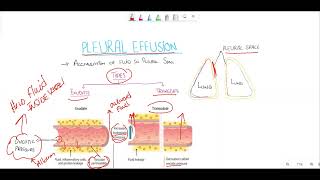 Pleural effusionTransudate vs exudate Light criteria [upl. by Adnical]