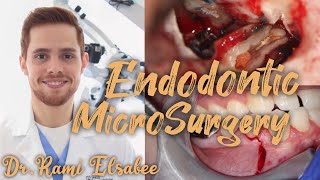 Endodontic Microsurgery  Root canal treatment  Dr Rami Elsabee [upl. by Caldwell]