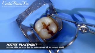 restoration of class 2 cavity adjacent to edentulous area tambalan resin komposit [upl. by Briney454]