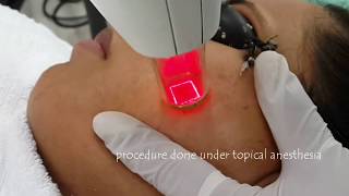 Laser treatment for acne scars  Fractional Non Ablative Laser  Dr Anuj Pall MD PhD FISD USA [upl. by Ahcsatan416]