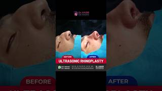 Transformative Rhinoplasty Before and After  Expert Nose Job Results [upl. by Anirac]