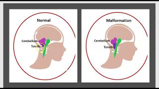 La Syringomyélie Malformation dArdnold Chiari LHydrocéphalie Maladie du Filum Syrinx Traitement 3m [upl. by Yolande]