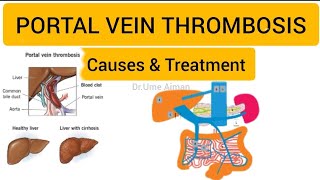 Portal Vein Thrombosis  How to treat PVT  in HindiUrdu [upl. by Prader]