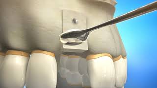 Bone Grafting Procedure Video Animation  Durham Dental Solutions [upl. by Ybanrab435]