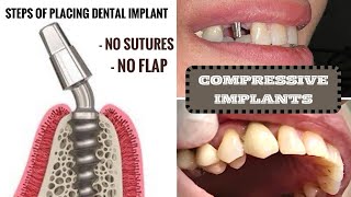 Steps of flapless painless Dental Implant  dentistry smilemakeover dentalimplants smile [upl. by Azriel]