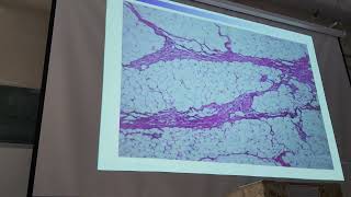 pathology practical hematoma [upl. by Gualtiero]