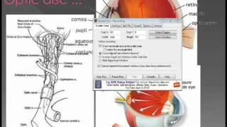 glaucoma pt 8 [upl. by Sillsby]