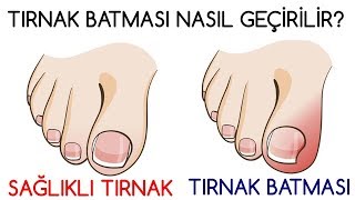 TIRNAK BATMASI NASIL GEÇİRİLİR [upl. by Ednil]