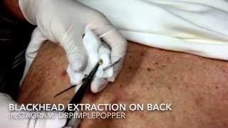 Blackhead on the back For medical education NSFE [upl. by Rutherfurd104]