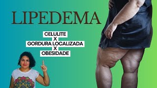 Como diferenciar Lipedema de gordura localizada celulite e obesidade sintomas [upl. by Snyder]