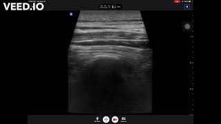 Bilateral erector spinae plane ESP block at T4 level for thoracic fusion surgery [upl. by Susette]