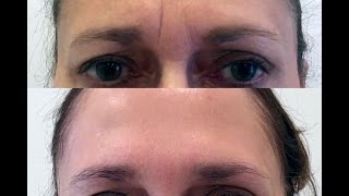 Forehead  Glabella quot11quot Rejuvenation with Botox and Restylane [upl. by Kulda]