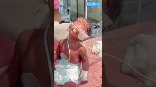 Newborn Poor Condition Baby medical nicu newbornbaby [upl. by Featherstone]