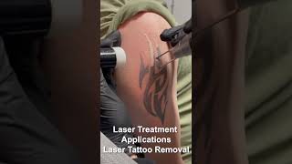 CO2 Laser Treatment ApplicationTattoo Removal laserbeam [upl. by Aymik]