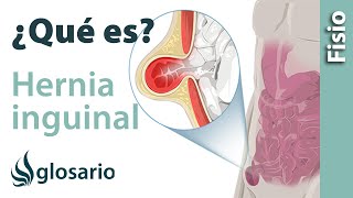 ❤ TRATAMIENTO MÉDICO para la Hernia Umbilical Funciona ❤ [upl. by Eelir]