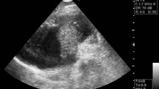 thrombosis in right atrium doppler echocardiographywmv [upl. by Yevi802]