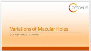 OCT Interpretation Session 3 Variations of Macular Holes [upl. by Harms]