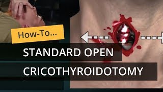 Standard Open Cricothyroidotomy [upl. by Consuelo244]