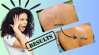 Amazing Natural Remedies for Eczema Relief  Bye Itchy Skin [upl. by Allesor]