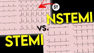 ECG interpretation  STEMI vs NSTEMI  ECG of Myocardial Infraction • Daily Cardiology [upl. by Ahsirahc]