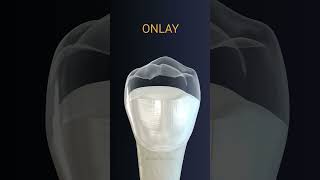 Onlay dental crown [upl. by Irakuy]