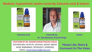 Nodular hypoechoic lesion cures by Calcaria carb amp Iodum [upl. by Barbette]