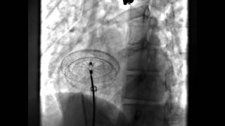 Unstable ASD occluder device position [upl. by Aihsaei]