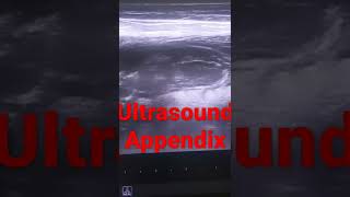 Appendix Ultrasound  Acute Appendicitis [upl. by Eimmot]