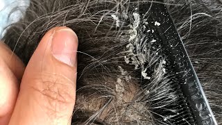 DANDRUFF REMOVAL FROM SCALP [upl. by Niarb]